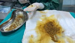 BİNGÖL`DE NADİR VAKA SAFRA KESESİNDEN 2067 TAŞ ÇIKTI